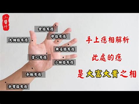 手上胎記|手上的胎記是什麼意思 